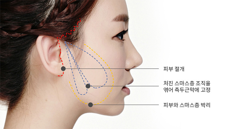 허쉬성형외과 맥스리프팅
