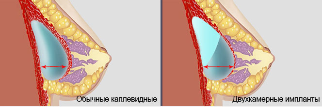 Каплевидные И Круглые Импланты Фото