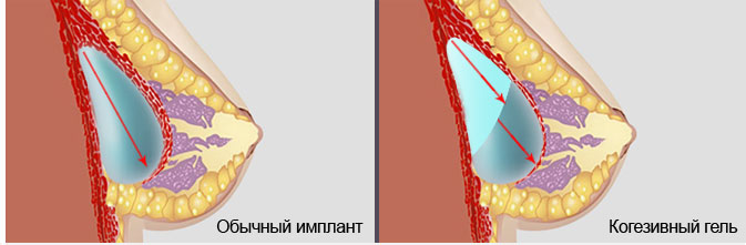 Имплант под грудную мышцу