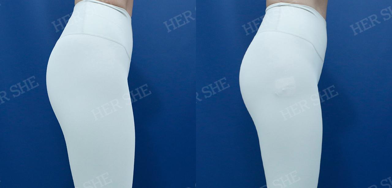 어깨성형 전후 비교