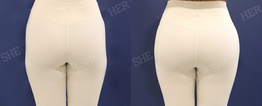 BEFORE & AFTER