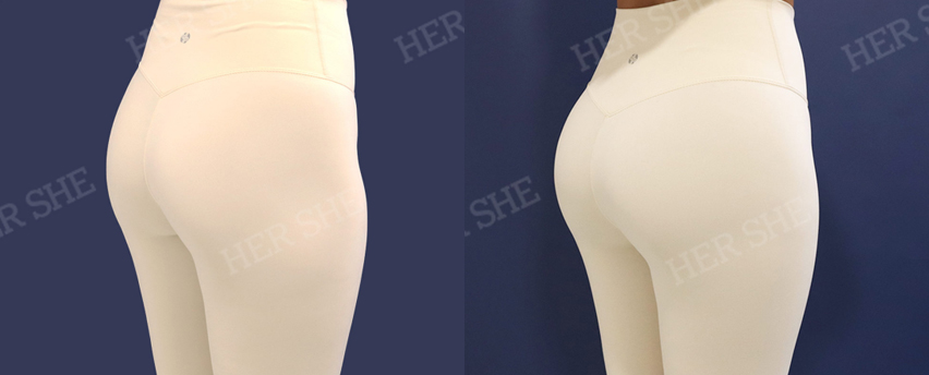 BEFORE & AFTER