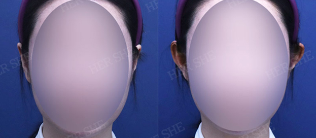 누운귀필러 + 사각턱톡신 전후