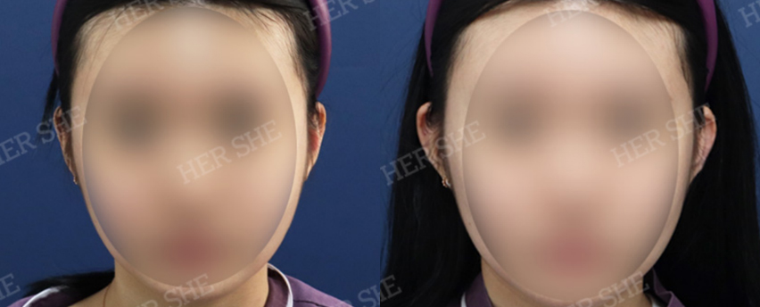 BEFORE & AFTER