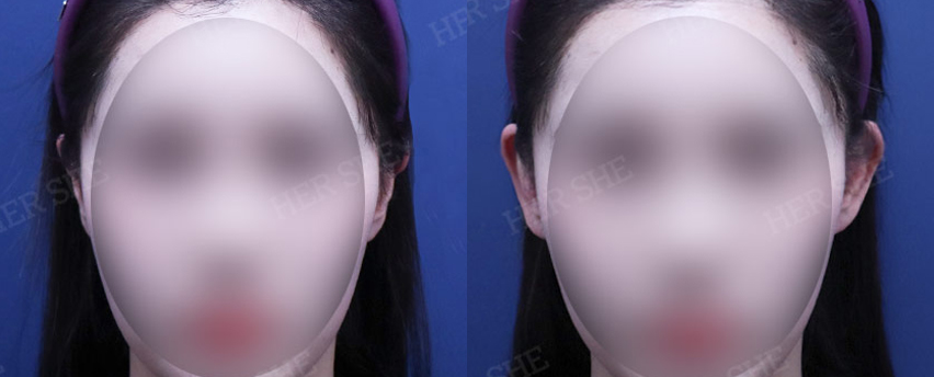 BEFORE & AFTER