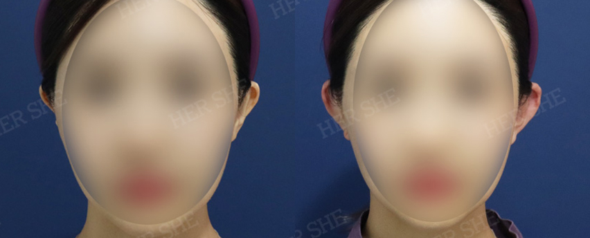 BEFORE & AFTER