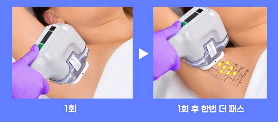 miraDry dual-pass treatment