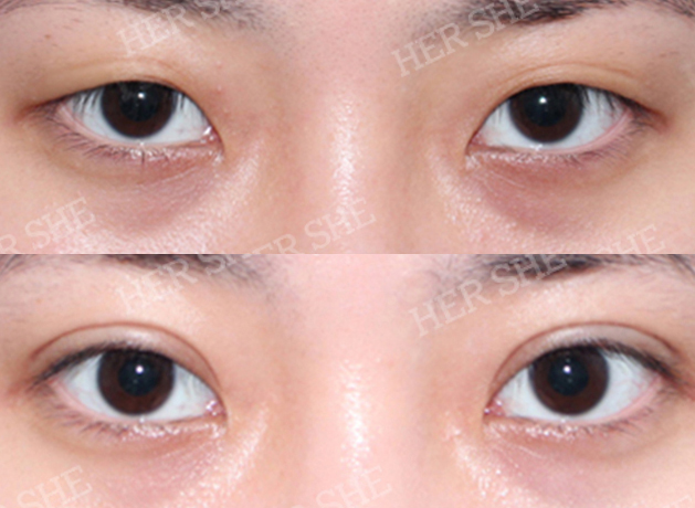 eye plastic surgery before&after