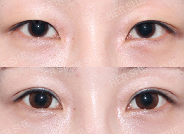 eye plastic surgery before&after