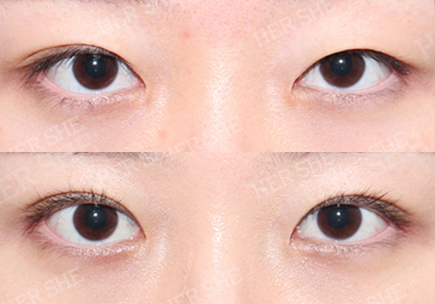 eye plastic surgery before&after