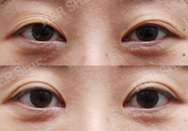 eye plastic surgery before&after