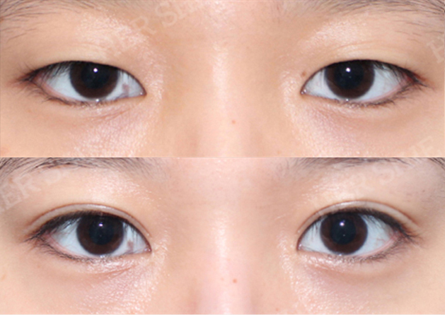 eye plastic surgery before&after