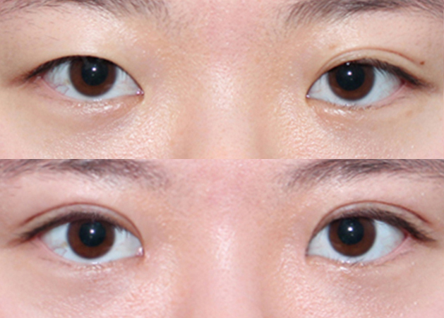 eye plastic surgery before&after