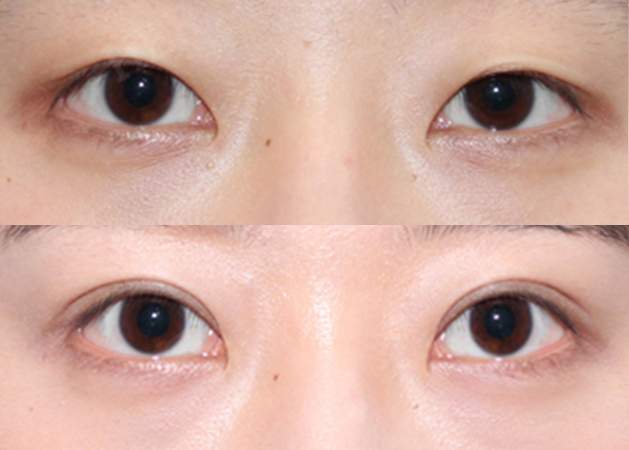 eye plastic surgery before&after