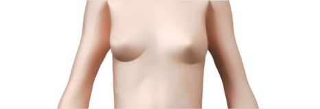 乳房修复术
