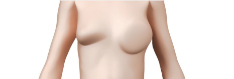 乳房修复术