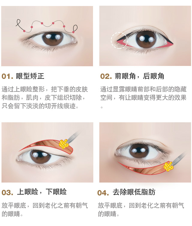 双眼皮