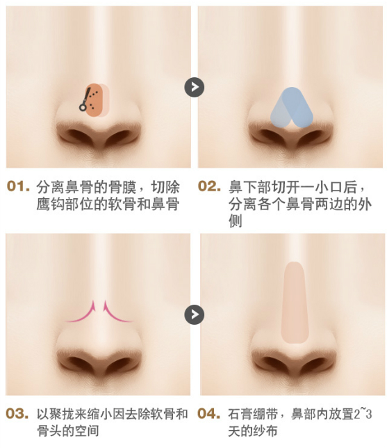 鹰钩鼻