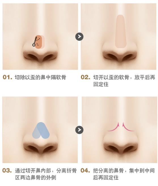 歪鼻